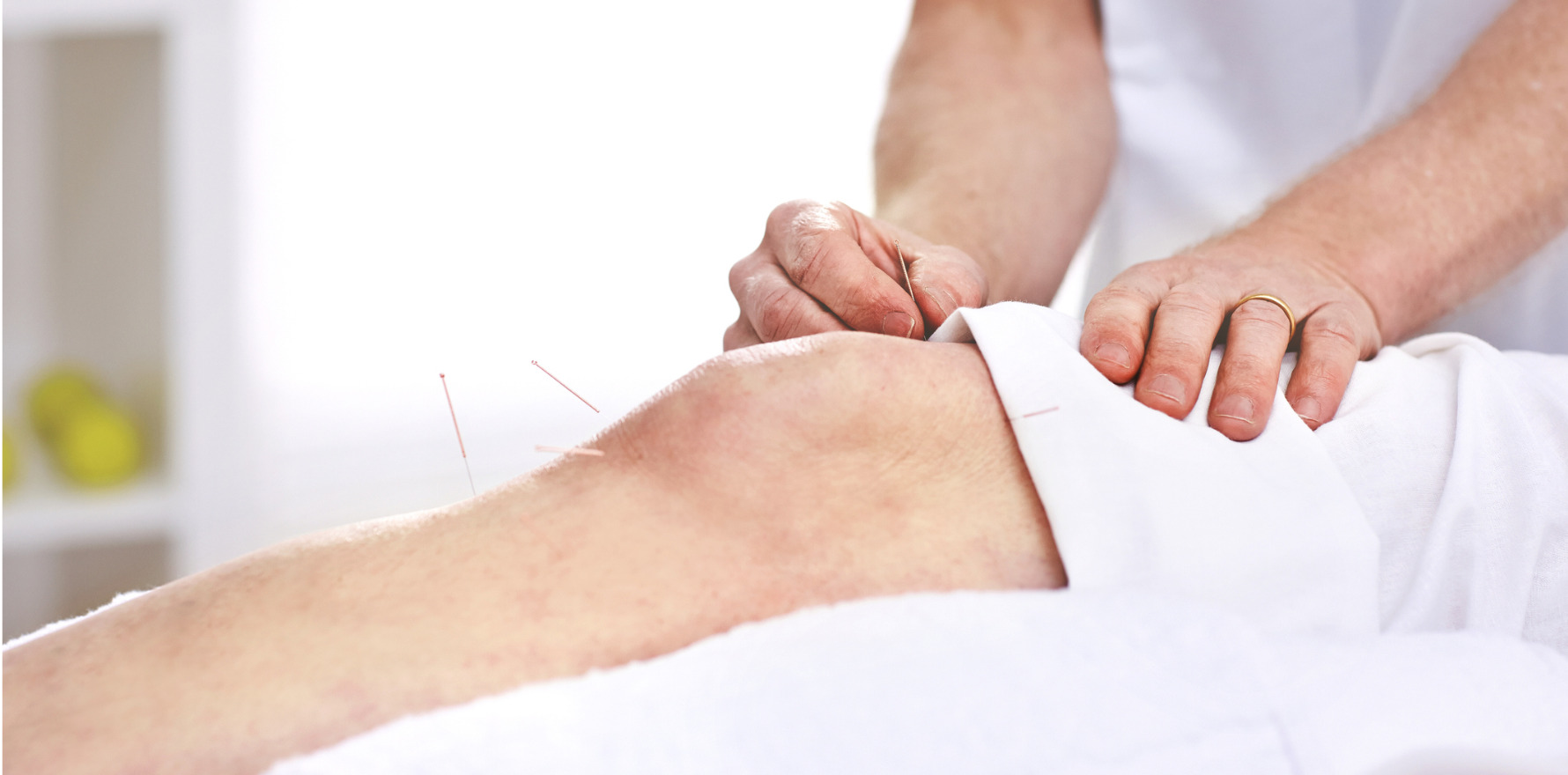 Acupuncture not sham for cancer arthralgia Oncology Republic